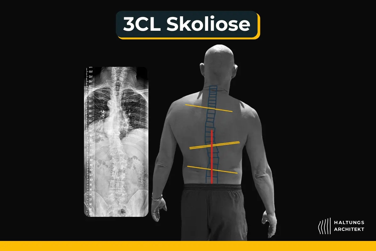 Thorakale Skoliose erkennen: 3 CL, 3BL, und S-Skoliose