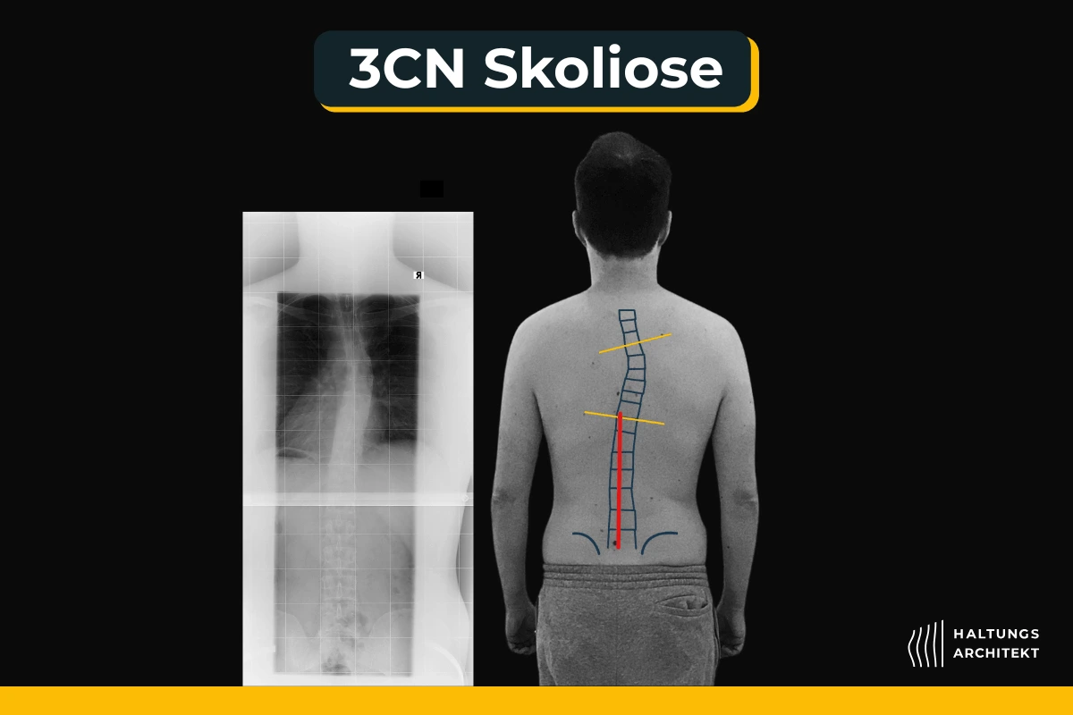 Thorakale Skoliose erkennen: 3 CN, 3BN, und C-Skoliose