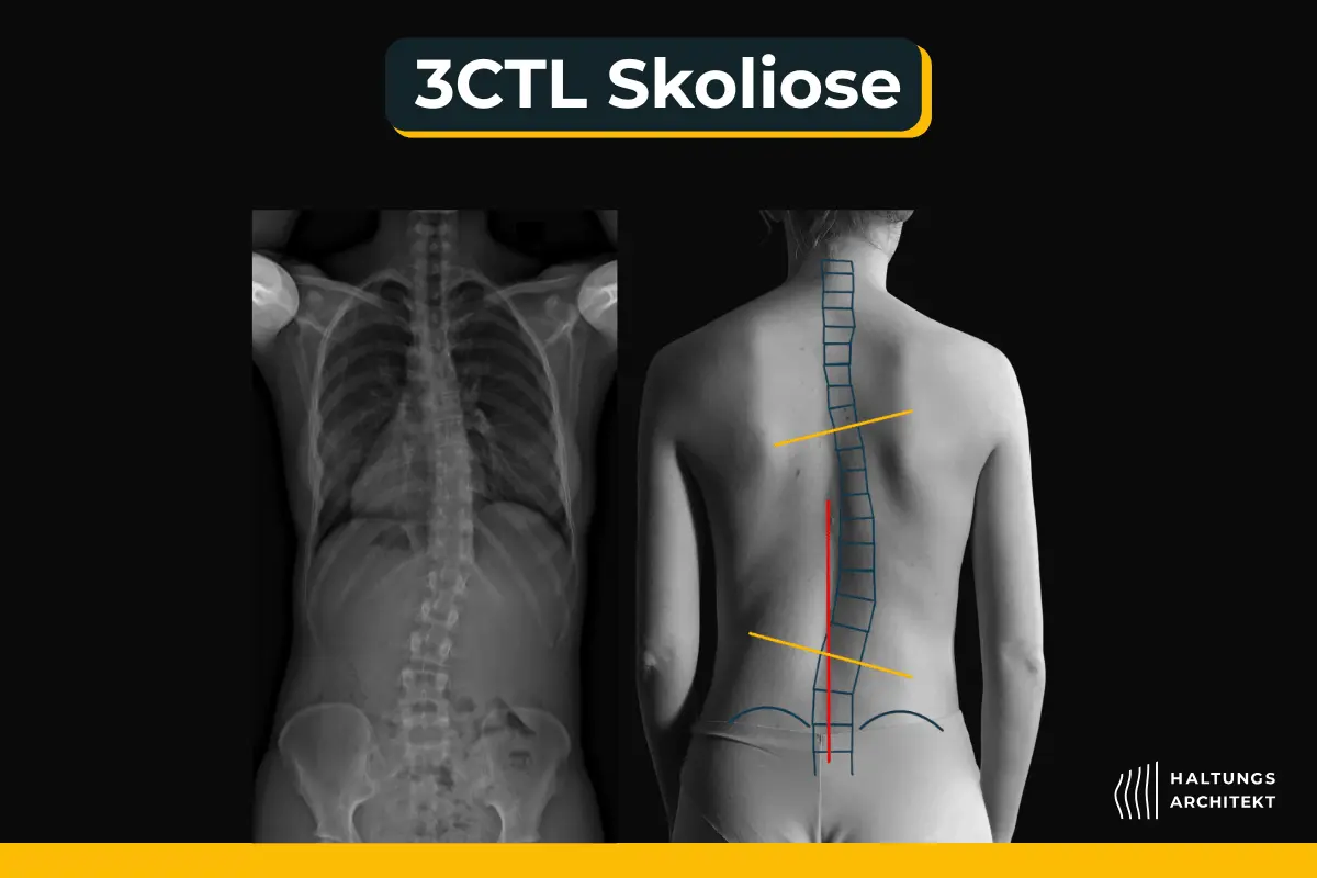 Thorakale Skoliose erkennen: 3 CTL, 3BTL, und C-Skoliose