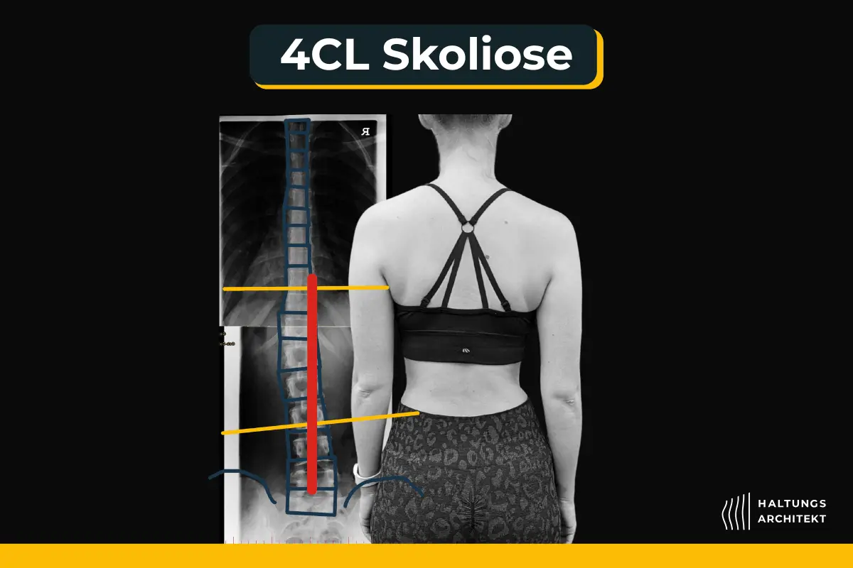 4CL, 4BL, lumbale Skoliose Skoliose erkennen