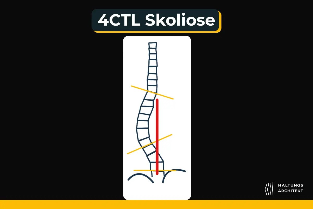 4CTL, 4BTL, lumbale Skoliose Skoliose erkennen