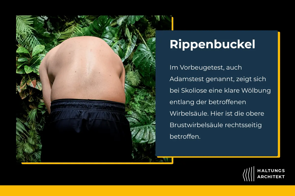 Rippenbuckel beim Adamstest als Zeichen einer thorakalen Skoliose