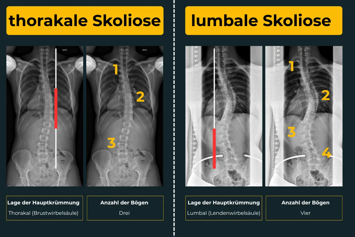 Unterscheidung von Skoliosen nach Hauptkrümmung und Anzahl der Bögen