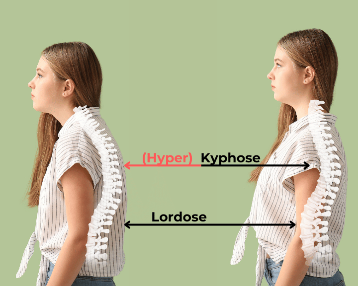 Kyphose und Lordoses erklärt